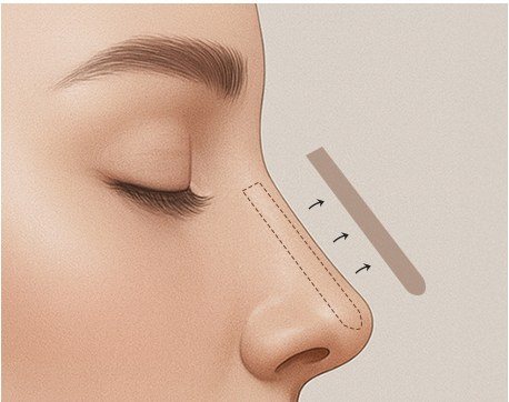 코 보형물 제거 과정을 나타낸 일러스트