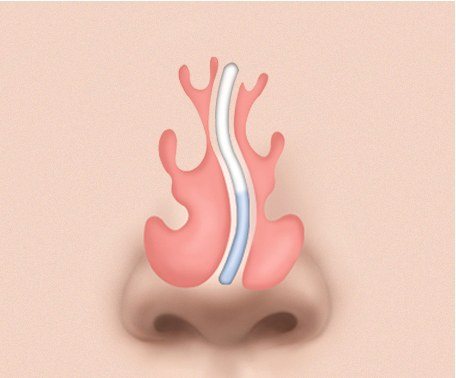 S형 비중격 만곡증 단면 일러스트