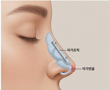 고정 및 봉합 단계 일러스트