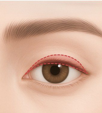 눈꺼풀 디자인 후 절개 일러스트