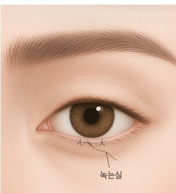 절제 및 봉합 시술 일러스트