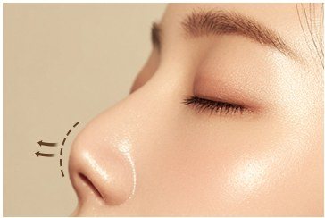코 끝 재교정 대상을 나타낸 일러스트