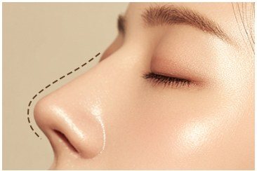 콧대 재수술 대상을 나타낸 일러스트