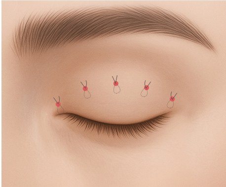 눈매교정 수술 디자인 과정 일러스트