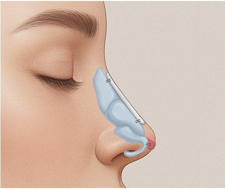 고정 및 봉합 일러스트