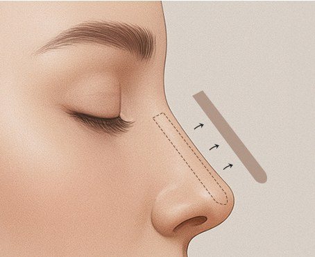 문제 조직 제거 일러스트
