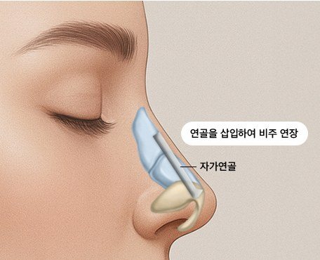 연골 구조 재설계 일러스트