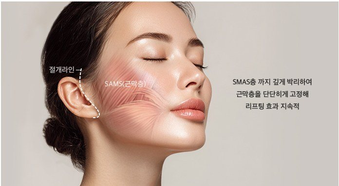 딥 미니거상의 SMAS층 박리 및 절개라인 설명 일러스트