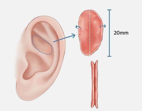 귀연골 채취 부위 및 크기 일러스트