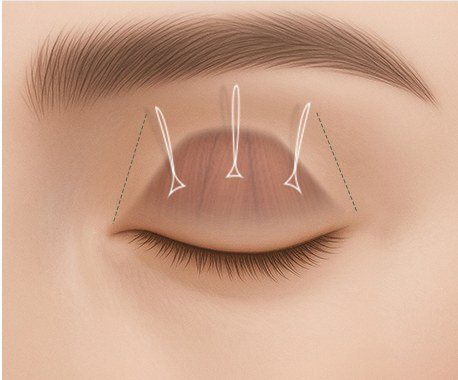 특수 실로 유착을 유도하는 과정 일러스트