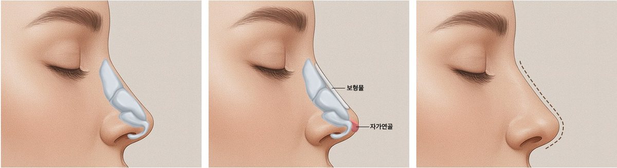 매부리 절골 후 라인 높이기 3단계 과정 일러스트