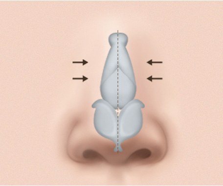 좌우 대칭 정렬 수술 과정 일러스트