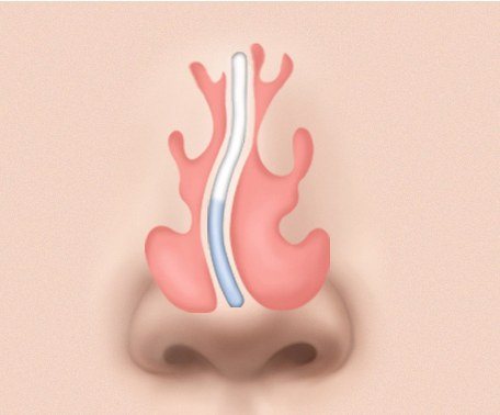 C형 비중격 만곡증 단면 일러스트