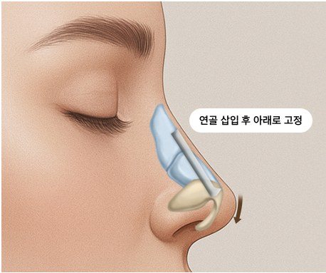 연골 연장 및 보강 단계 일러스트