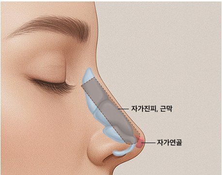 코에 자가진피, 근막, 자가연골을 이식하는 과정을 나타낸 일러스트