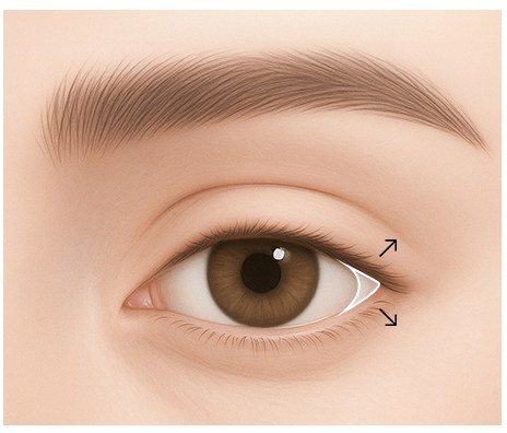 뒤트임 수술 과정 일러스트