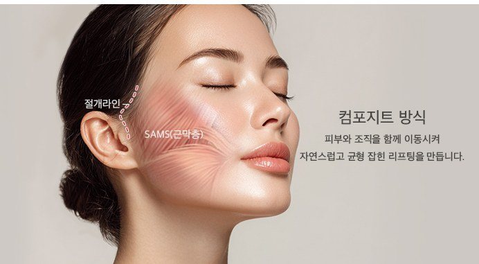 히든딥미니거상 컴포지트 방식 절개라인 및 SAMS 근막층 설명 일러스트