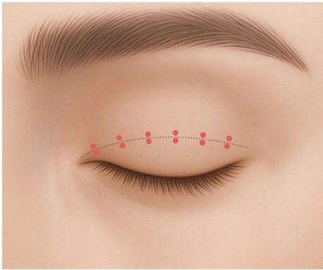 디자인 후 절개 수술 과정 일러스트