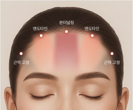 펜타픽스 이마거상 복합 고정 포인트 일러스트