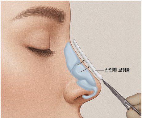절개 및 박리 단계 일러스트