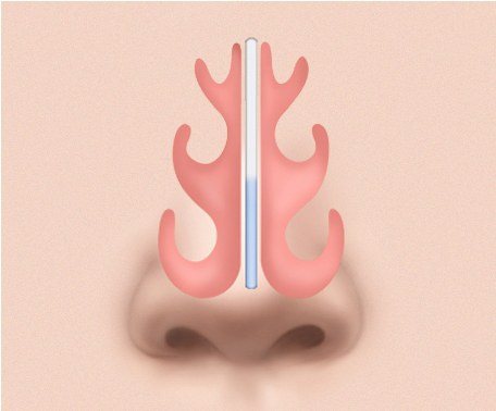 정상적인 비중격 단면 일러스트