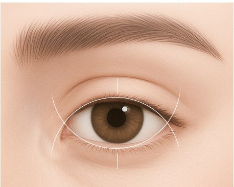 투웨이 앞트임 수술 디자인 일러스트