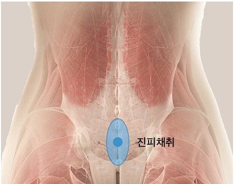 엉덩이 및 허벅지 부위 자가진피 채취 위치를 나타낸 해부도 일러스트
