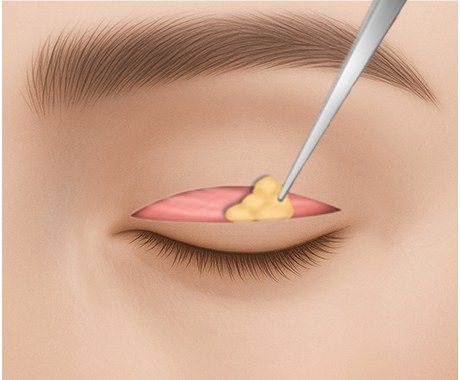 눈꺼풀 지방 제거 일러스트