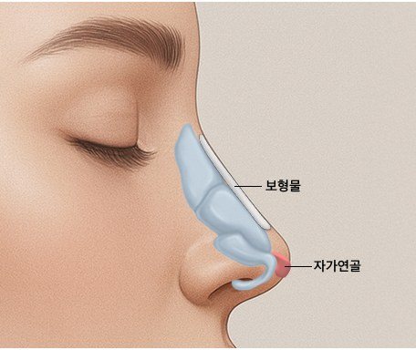 보형물 또는 자가조직 삽입 일러스트