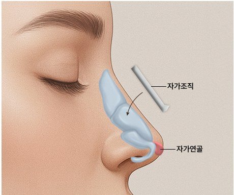 자가조직 삽입 단계 일러스트