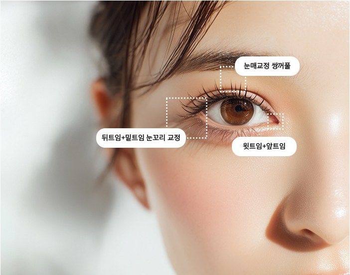 눈매교정, 뒤트임, 윗트임+앞트임 등 수술 부위가 표시된 눈 클로즈업 사진