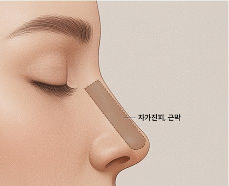 연부조직 재건 일러스트