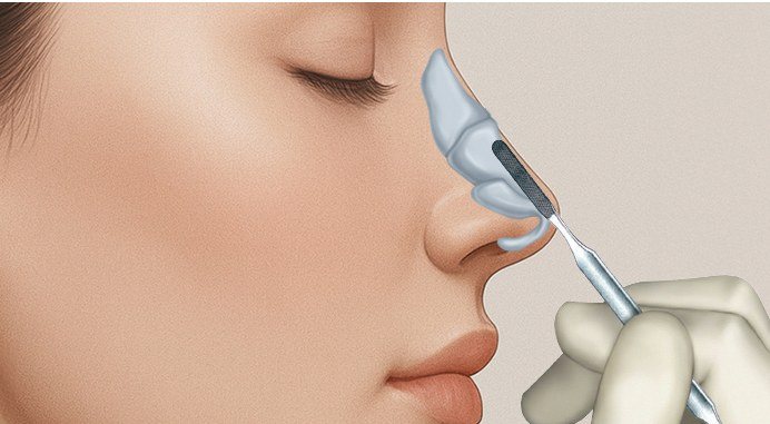 메부리 절골 및 연골 절제 수술 과정 일러스트