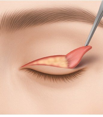 유착 및 흉터 조직 박리 과정 일러스트
