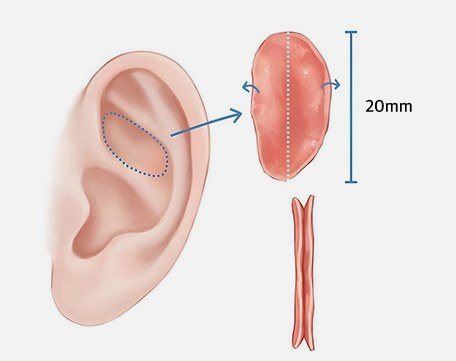 귀연골 채취 부위 및 크기 일러스트