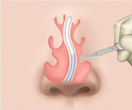 연골 분리 수술 과정 일러스트