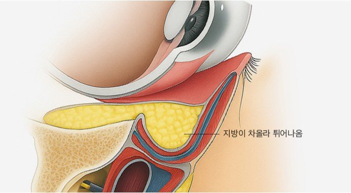 깨끗하게 박리하지 못한 경우의 눈 밑 지방 일러스트