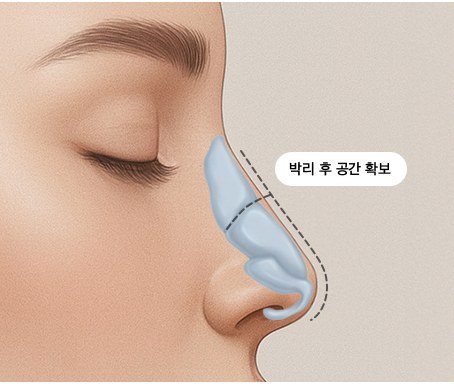 구조 정리(절개 및 박리) 일러스트