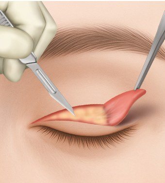 늘어진 피부 절개 및 제거 일러스트